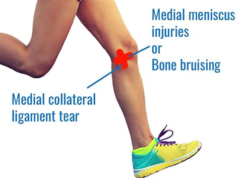 medial knee pain when running: Exploring Various Factors and Strategies for Runners